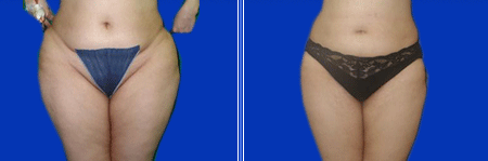Mega Liposuction Surgery in India